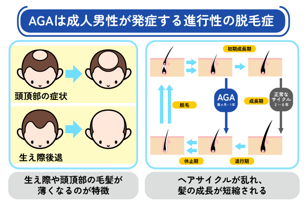 AGAの症状を説明する図